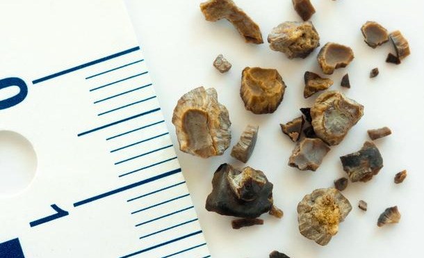 有什么食物可以預(yù)防結(jié)石的形成?深圳送菜公司?為您解讀